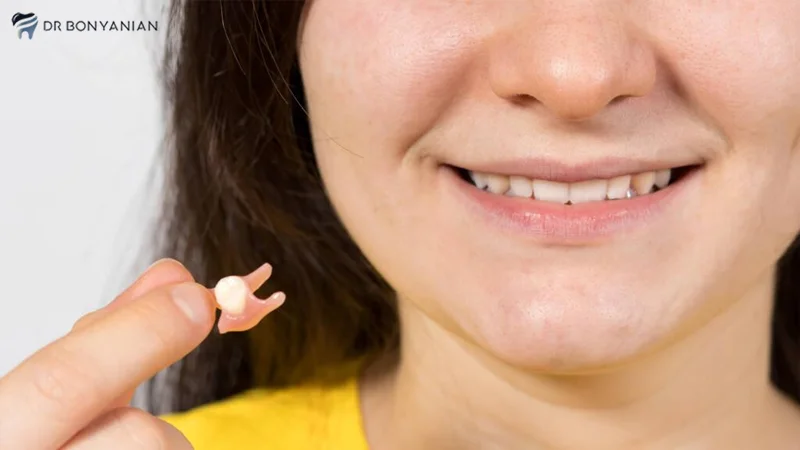 Disadvantages of single-bonded fixed dentures