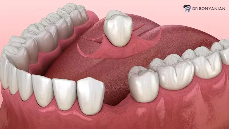 Single-Tooth Adhesive Denture: Pros, Cons & Cost